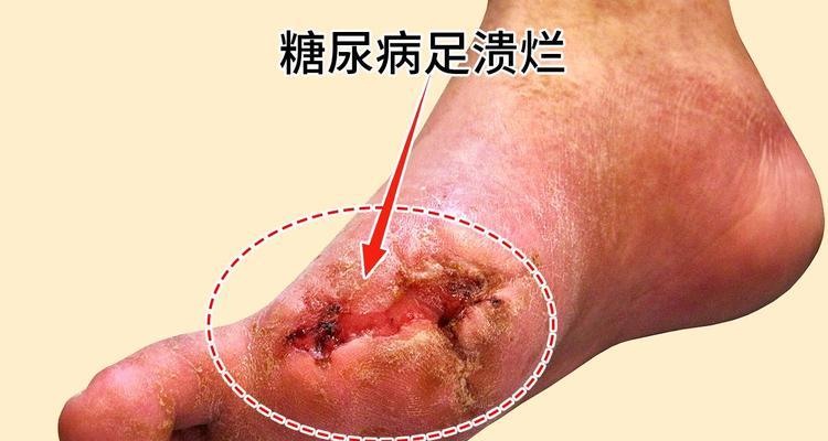 冰柜中滋生蛆虫的处理方法（消除冰柜蛆虫的有效技巧）